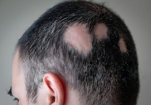 Alopecia treatment, advice and consultancy, Sheffield, by Scott's Hair Loss Consultancy.