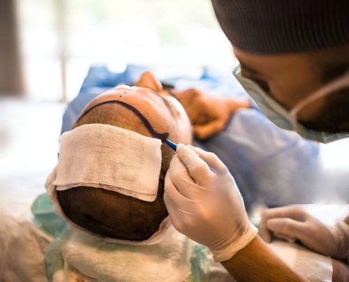 Hair transplant treatment, Sheffield