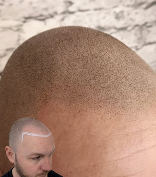 Scalp micropigmentation treatment, Sheffield